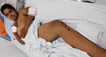 Garoto de Lagoa Formosa que teve perna fraturada em acidente pede ajuda para realizar cirurgia Garoto de Lagoa Formosa que teve perna fraturada em acidente pede ajuda para realizar cirurgia