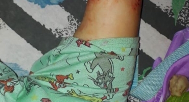 Lagoa Formosa: Secretaria de Saúde esclarece sobre tratamento de garotinho com dermatite Lagoa Formosa: Secretaria de Saúde esclarece sobre tratamento de garotinho com dermatite