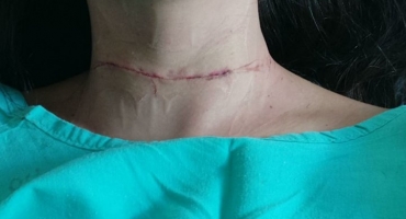 Após cirurgia motociclista atingida por linha de pipa diz que passa bem