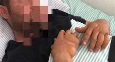 Homem de Lagoa Formosa que sofreu queimaduras de 3º grau tentando apagar incêndio em lavoura aguarda transferência para Belo Horizonte Homem de Lagoa Formosa que sofreu queimaduras de 3º grau tentando apagar incêndio em lavoura aguarda transferência para Belo Horizonte