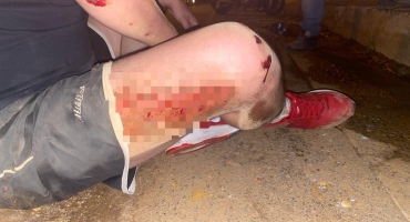 Carmo do Paranaíba – Ciclista não percebe alteração em quebra-molas, cai e fica ferido no bairro Alvorada Carmo do Paranaíba – Ciclista não percebe alteração em quebra-molas, cai e fica ferido no bairro Alvorada