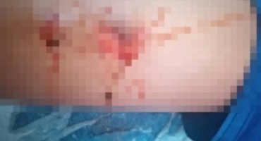 Patos de Minas - Adolescente é atacado por pitbull no bairro Coração Eucarístico e dono do animal é preso Patos de Minas - Adolescente é atacado por pitbull no bairro Coração Eucarístico e dono do animal é preso