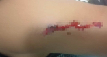 Garoto de 10 anos é ferido por tiro de espingarda no bairro Niterói; em Carmo do Paranaíba 